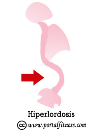 Hiper Lordosis Compensatoria